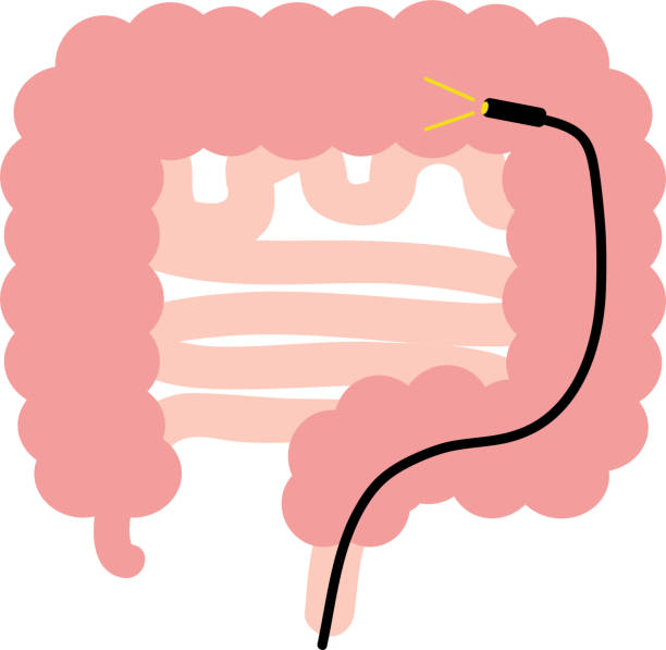 Colonoscopy - Dr. Saiprasad Lad - Best Gastroenterologist in Mumbai